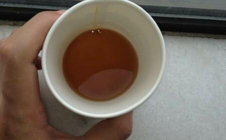 男子血尿一年多才去医院, 确诊后吓摊在地