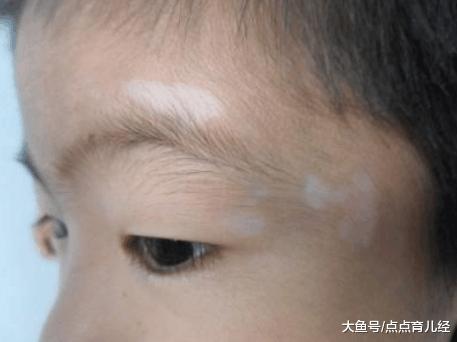 小孩7岁脸上长白块晚上睡觉磨牙出汗是不是应该补钙和