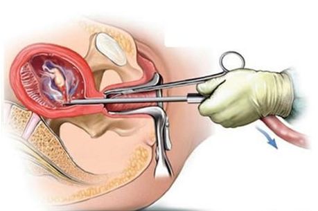 女子流产时孩子是怎样"打掉"的,看完你还敢流产吗?