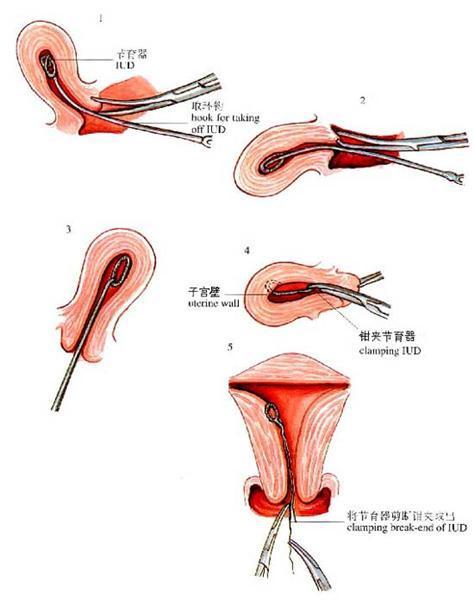 作为老公你知道女性上环是什么意思揭秘上环全过程要疼老婆
