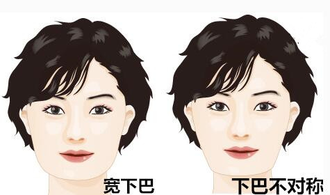 vline瓜子脸手术有哪些差别？