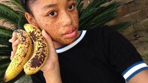 美国18岁“烂香蕉”女孩, 满脸黑斑, 却成时尚模特!