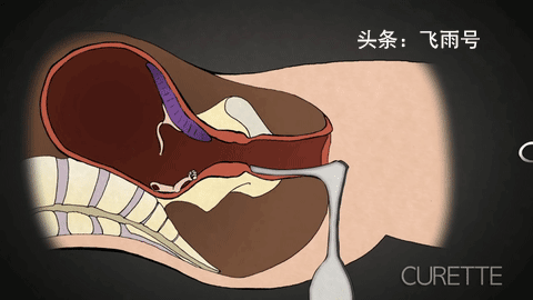 做人流后有什么反应