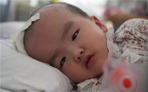 新生儿的头越来越大,如何诊断鉴别是不是脑积水