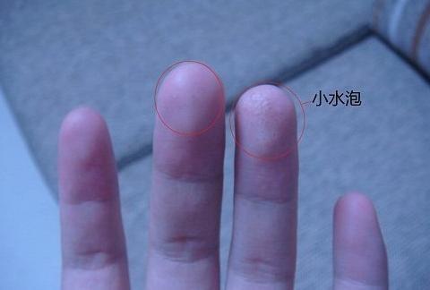 手指突然长水泡,要当心了,可能是身体"中毒"太深的