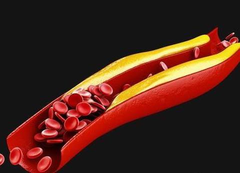 血脂异常症状表现 高血脂有哪些危害