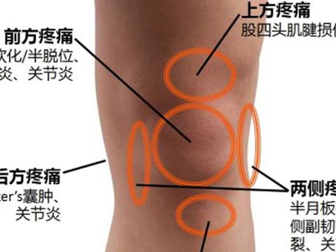 一个方法打败骨科教授,专治膝盖滑膜炎的妙招,用过的都说好