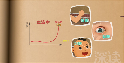 新生儿黄疸,胆红素,和孩子脑瘫,智力发育迟缓那