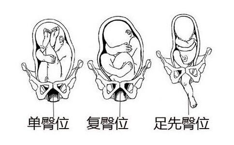 "挪移法"可让胎儿在子宫内翻转 臀位宝宝照样能顺产