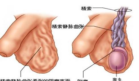 精索静脉曲张为什么常见，左侧比右侧更多见，看了这个就知道了!