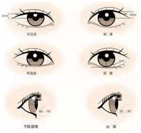 为什么我们不适合做欧式双眼皮?欧式双眼皮和