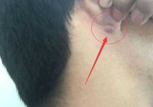耳朵后面长了个硬包是怎么回事? 专家说: 要当