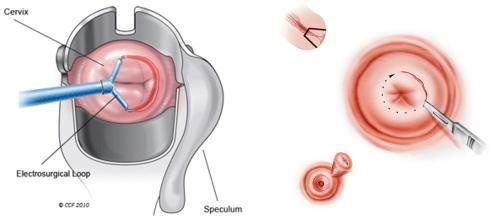 「备孕时,我查出了宫颈癌前病变」系列之二:用