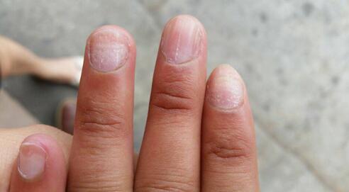 灰指甲,大名甲癣,是指皮癣菌感染到甲板或甲板下所引起的疾病.