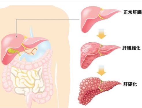 肝硬化的第一标志是什么东西?