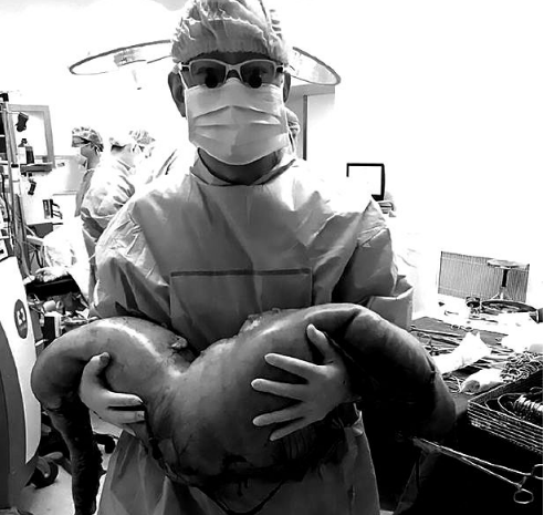 男子便秘近30年,一直靠泻药排便,手术切下的东