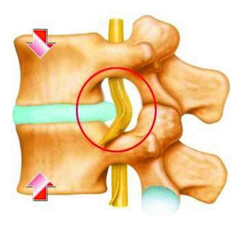 一个单亲妈妈的故事: 腰椎间盘突出压迫下的绝