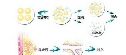 【自脂丰胸太痛苦了】 自体脂肪丰胸后很后悔自身脂肪丰胸安全吗