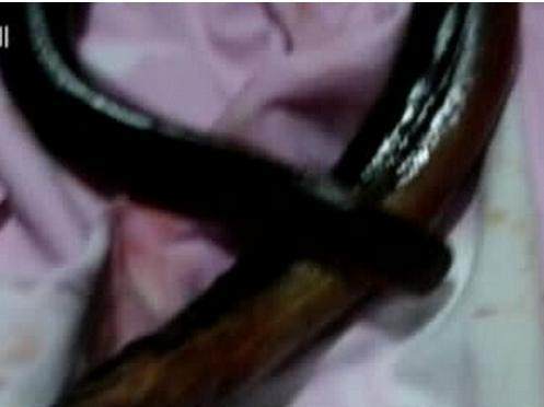 女子下河洗澡不慎竟被黄鳝钻入肛门！左后落得如此下场