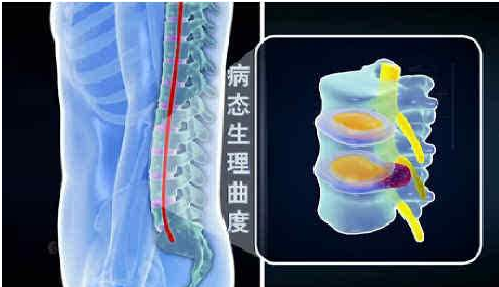 几万治不好的腰突,这个方法帮你搞定,就是这么