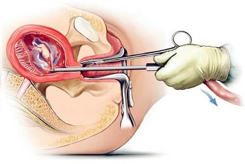 产妇隐瞒生育史,差点把孩子生在厕所里!网友表