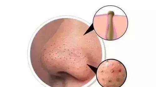 去黑头,这些坑99%的人都栽进去过