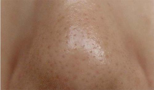 孔粗大, 鼻子白色颗粒多, 说明有螨虫, 3妙招清