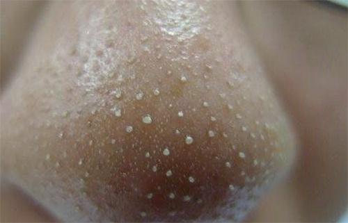 孔粗大, 鼻子白色颗粒多, 说明有螨虫, 3妙招清