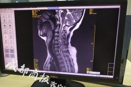 手机族小心了：每天躺着玩手机2小时！40岁男子突发全身瘫痪