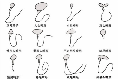 畸形精子长成什么样子你知道吗?备孕的男性要