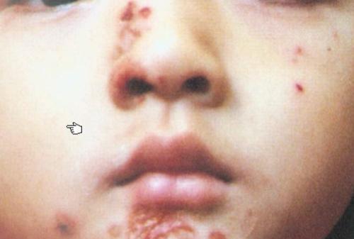 小儿疱疹性口炎病因、表现和治疗要点