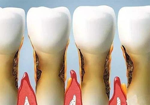 口腔医生揭秘:这类牙膏是牙斑菌的死对头,能有