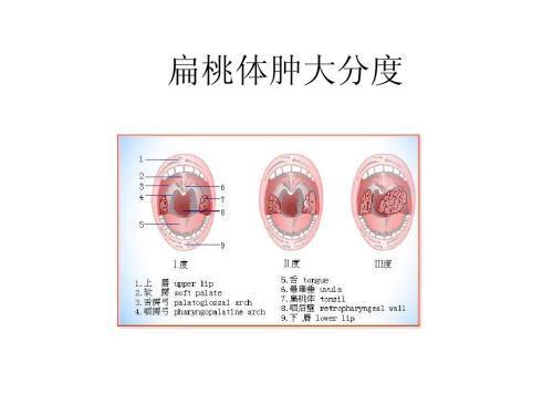 扁桃体肿大就得手术摘除? 医生教你应对扁桃体和腺样体肿大