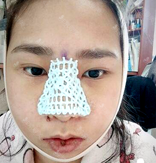 韩国GNG整形医院崔荣达院长面部轮廓手术让