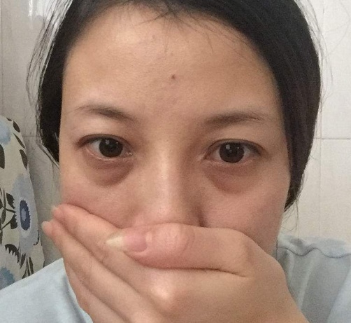 眼袋是怎么形成的?用这种水果早晚敷一敷,一周