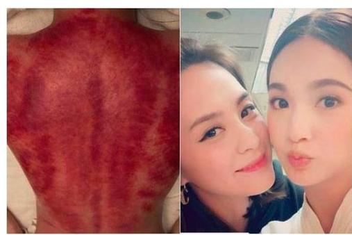 阿娇晒刮痧照香肩玉背荡然无存,李冰冰贾乃亮