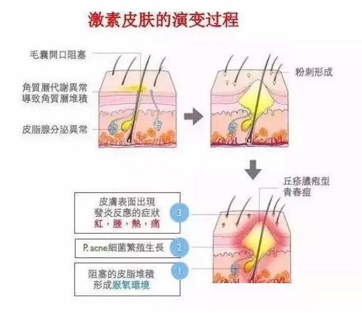 脸反复过敏是激素脸吗? 激素脸反复过敏, 一直