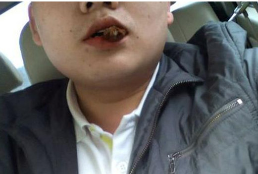 槟榔加烟,法力无边,27岁小伙住进ICU,医生:见