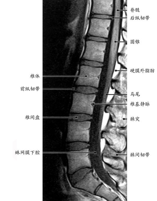 疼痛多发于下腰椎(最下面的两个部位,即腰4和腰5之间和腰5和骶1之间)