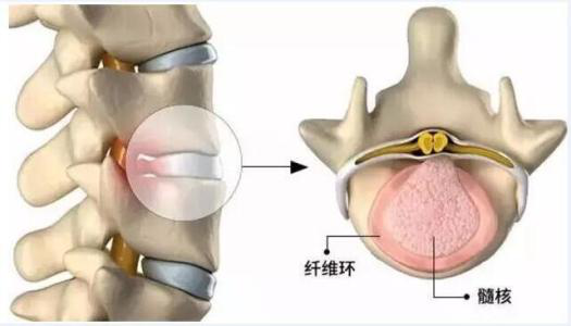 腰间盘膨出疼痛难忍,多方求治,教训惨痛!