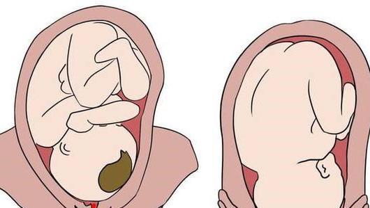 临产胎儿缺氧致死,怀孕后上厕所这个习惯别再
