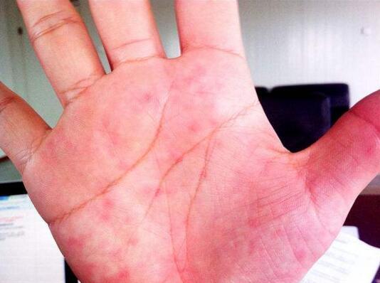 在肝癌初期, 皮肤上有6个细微变化, 错过可能就