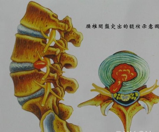 腰椎间盘突出患者自述，只用一个小方法，在家根除了颈椎病，