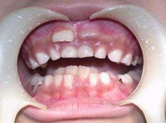 8岁宝宝长出畸形双排牙, 到医院检查后,宝妈肠