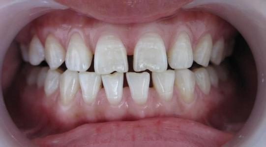 6个小方法解决困扰已久的牙缝问题