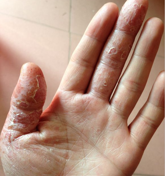 患有手指湿疹的患者最好要及时关注我们的手部湿疹状况.