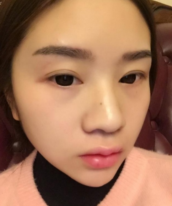 脸上斑点还去激光?药店里的它竟是斑点克星,祛