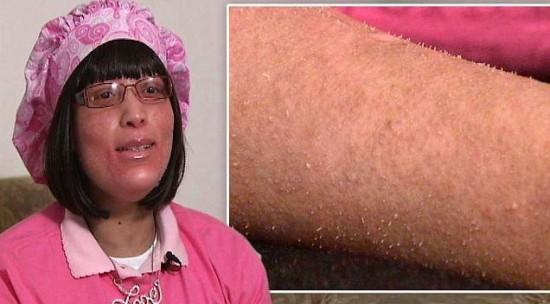 美国一女子身患怪病,毛孔里长出来的不是毛发