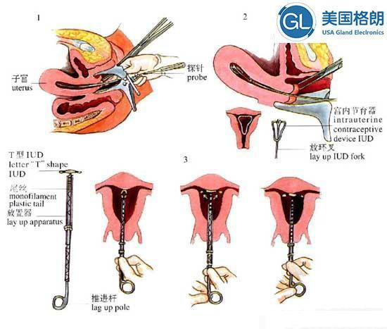 二胎剖腹产时，该不该连结扎手术一起做?你有透彻了解过吗?