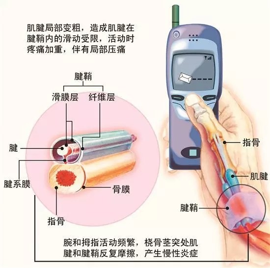 右手大拇指疼的不能弯曲 赵治伟 玩手机玩出了腱鞘炎 腱鞘炎 肌腱 玩手机 新浪新闻